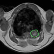 Small Cell Lung Cancer