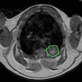 Small cell lung cancer